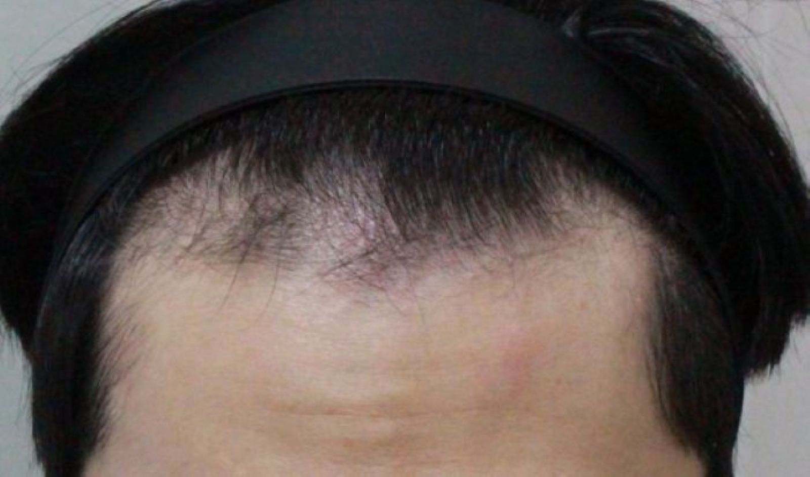 의정부탈모병원